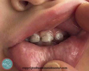 Photo montrant une bouche d'enfants avec des dents cariées. 