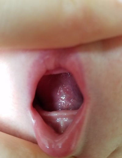 Image d'une bouche de bébé après une frénectomie pour cause de frein restrictif buccal.