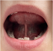 Photographie d'une bouche d'enfant ouverte pour illustrer la mobilité de la langue.